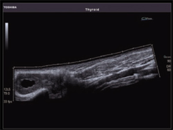 Ultrasonograf , aparat USG Toshiba XARIO SSA-660A 3D, ADF, obrazowanie panoramiczne